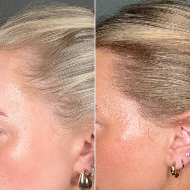 What are the main causes of female hair loss and is it reversible?