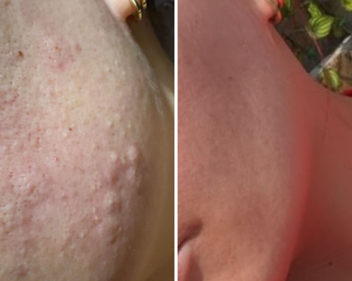 Acne & Blemishes