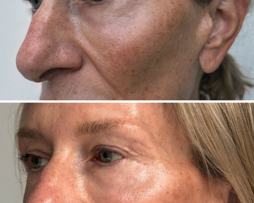 Hyperpigmentation