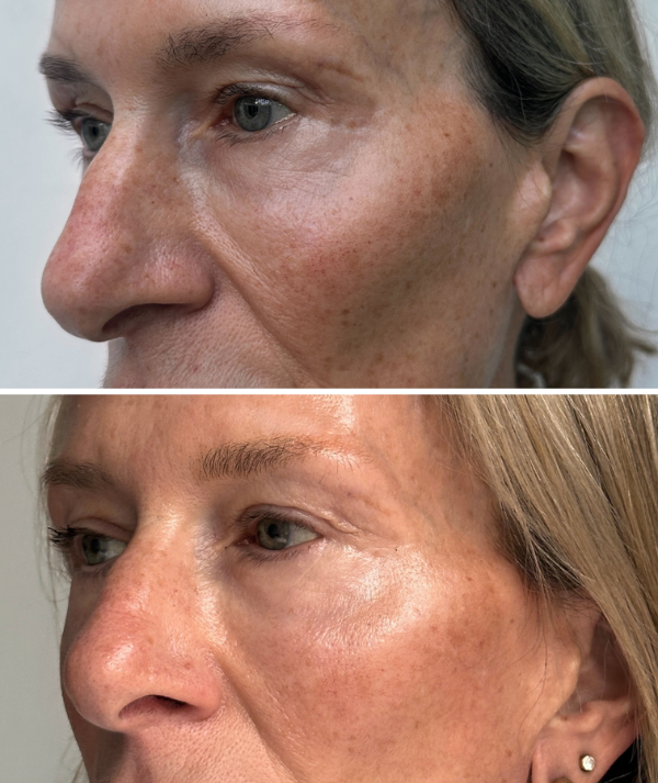 Hyperpigmentation